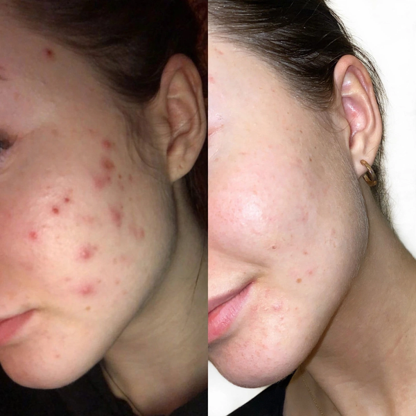 Acne Soap - Image 3